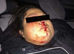 Woman hit in head by -less-than-lethal- ammunition - photo provided by steve gross